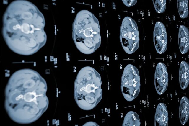 تشخیص زودهنگام سرطان لوزالمعده با مدل جدید هوش مصنوعی تشخیص زودهنگام سرطان لوزالمعده با مدل جدید هوش مصنوعی