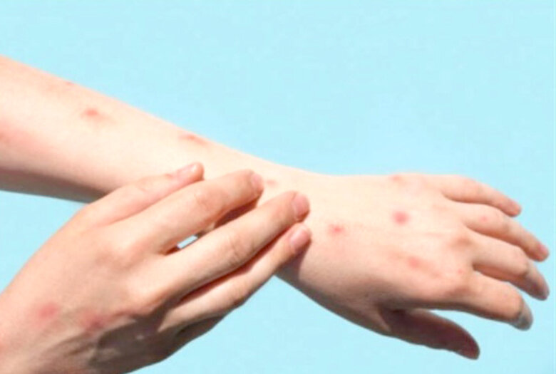 علائم و نحوه انتقال آبله میمونی / اقدام سریع و شفاف؛ خواسته WHO از کشورها علائم و نحوه انتقال آبله میمونی / اقدام سریع و شفاف؛ خواسته WHO از کشورها