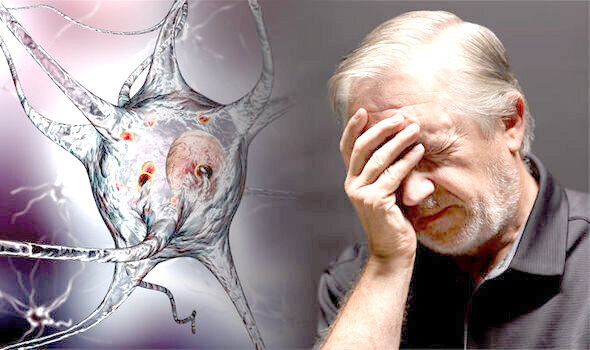 آلزایمر ناشی از اختلال در سیستم ایمنی داخل مغز است آلزایمر ناشی از اختلال در سیستم ایمنی داخل مغز است