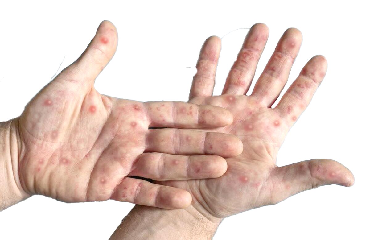 شیوع «آبله میمونی» در آفریقا؛ شمار قربانیان از ۱۰۰۰ تن گذشت شیوع «آبله میمونی» در آفریقا؛ شمار قربانیان از ۱۰۰۰ تن گذشت