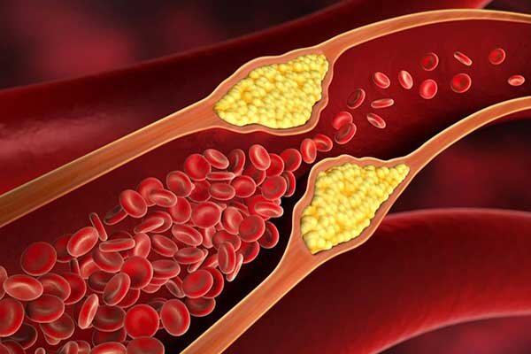 از کجا بفهمیم چربی خون داریم؟