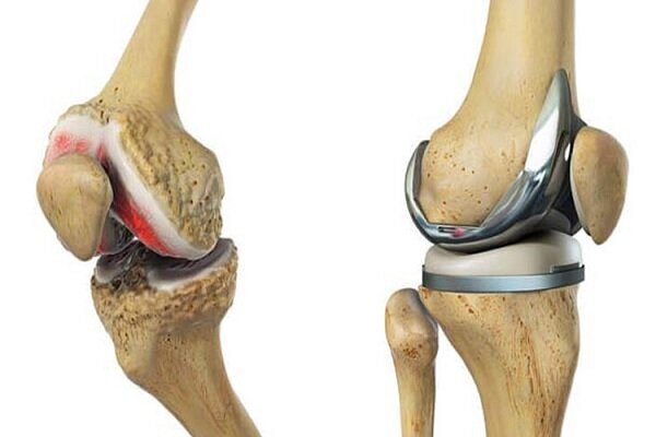 طراحی و ساخت ایمپلنت مکمل پروتز زانو با قدرت تثبیت استخوانی بیشتر