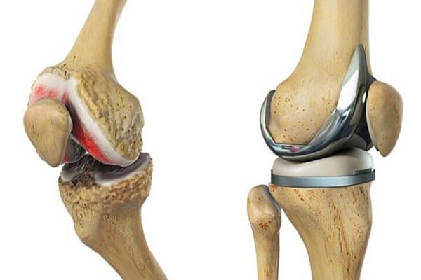 طراحی و ساخت ایمپلنت مکمل پروتز زانو با قدرت تثبیت استخوانی بیشتر طراحی و ساخت ایمپلنت مکمل پروتز زانو با قدرت تثبیت استخوانی بیشتر