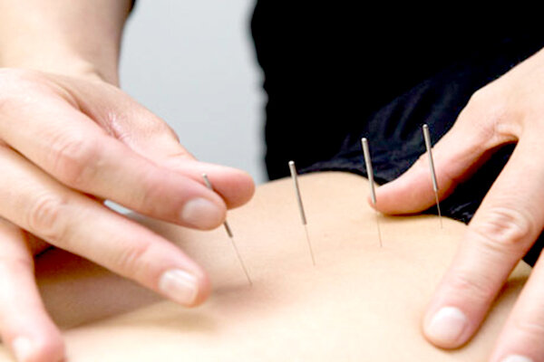آیا طب سوزنی برای کمردرد مفید است؟ آیا طب سوزنی برای کمردرد مفید است؟