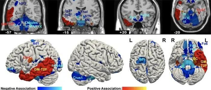 حجم مغز افراد روانآزار، کمتر است حجم مغز افراد روانآزار، کمتر است