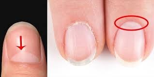 آیا سفیدی ناخنها نشانه کمخونی است؟ آیا سفیدی ناخنها نشانه کمخونی است؟