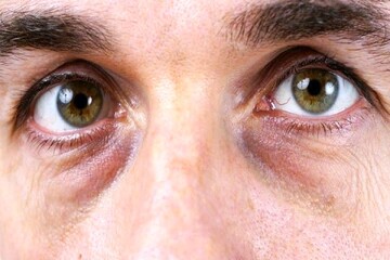«چشم پاندایی» چیست؟