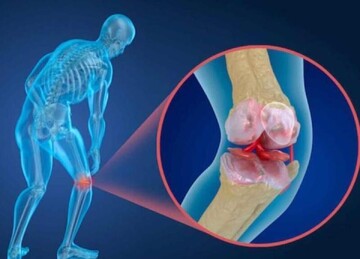 علت صدا دادن مفاصل هنگام حرکت؛ چه زمانی نگران شویم؟