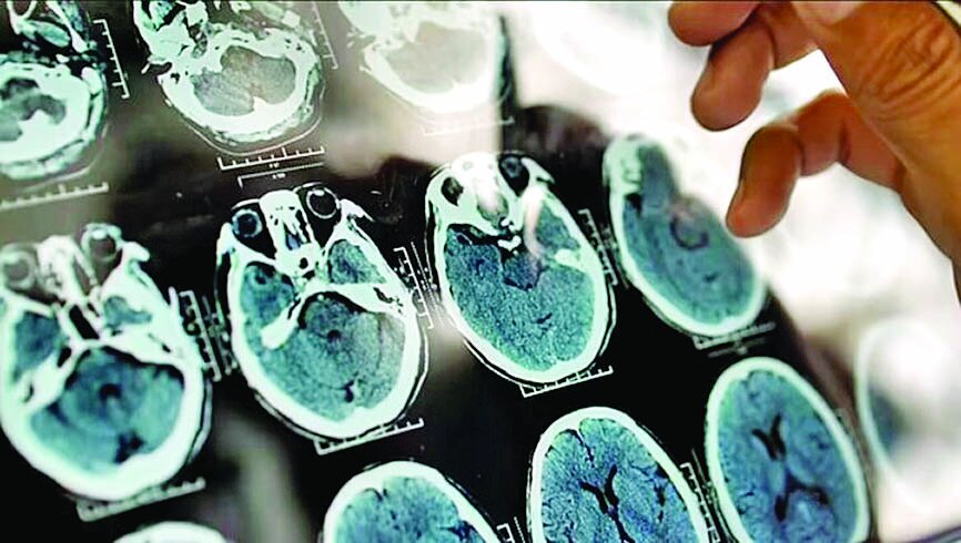 با مصرف پنیر از آلزایمر نجات پیدا کنید