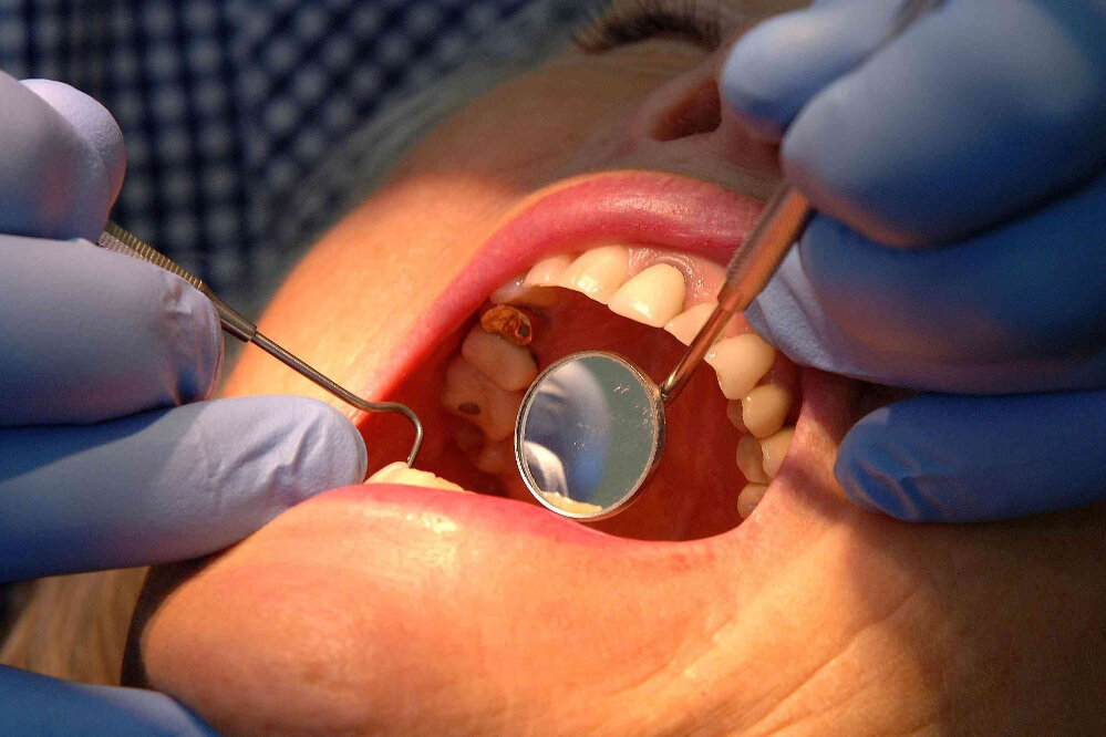 ژل جدید، پوسیدگی دندان را  بهتر درمان می‌کند