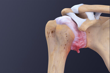 شانه یخ‌زده چیست؟