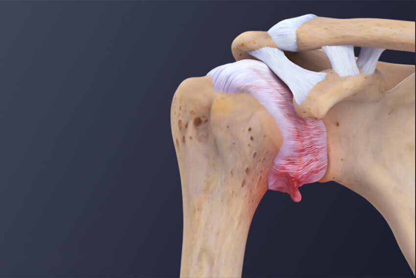 شانه یخ‌زده چیست؟