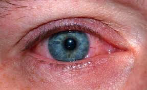 برف‌کوری چیست؟