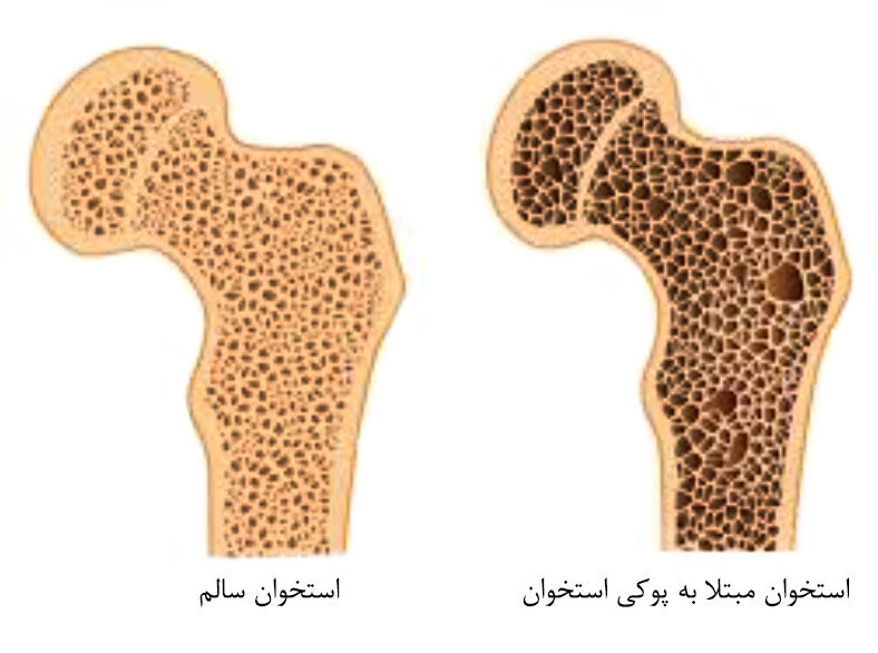 استخوان‌هایی که پوک می‌شوند