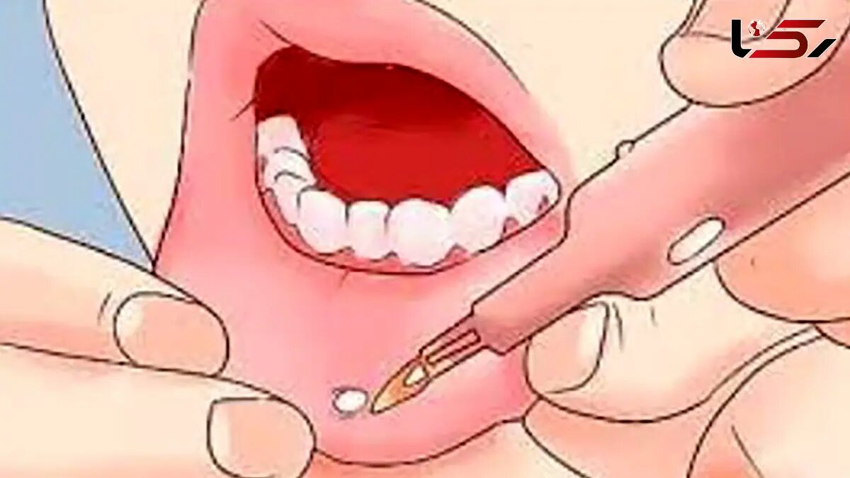 روش‌های خانگی درمان زخم دهان