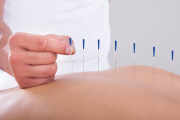 طب سوزنی برای سیاتیک آیا سوزن‌ها از قرص‌ها موثرترند؟