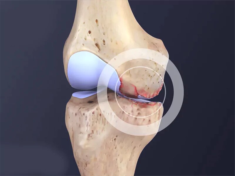 چه کنیم آرتروز نگیریم؟