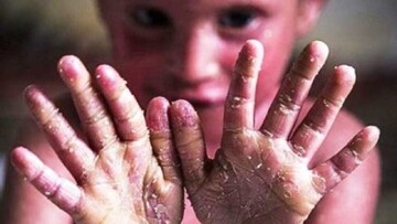 واریز دو میلیارد تومان به حساب هر بیمار ای‌بی
